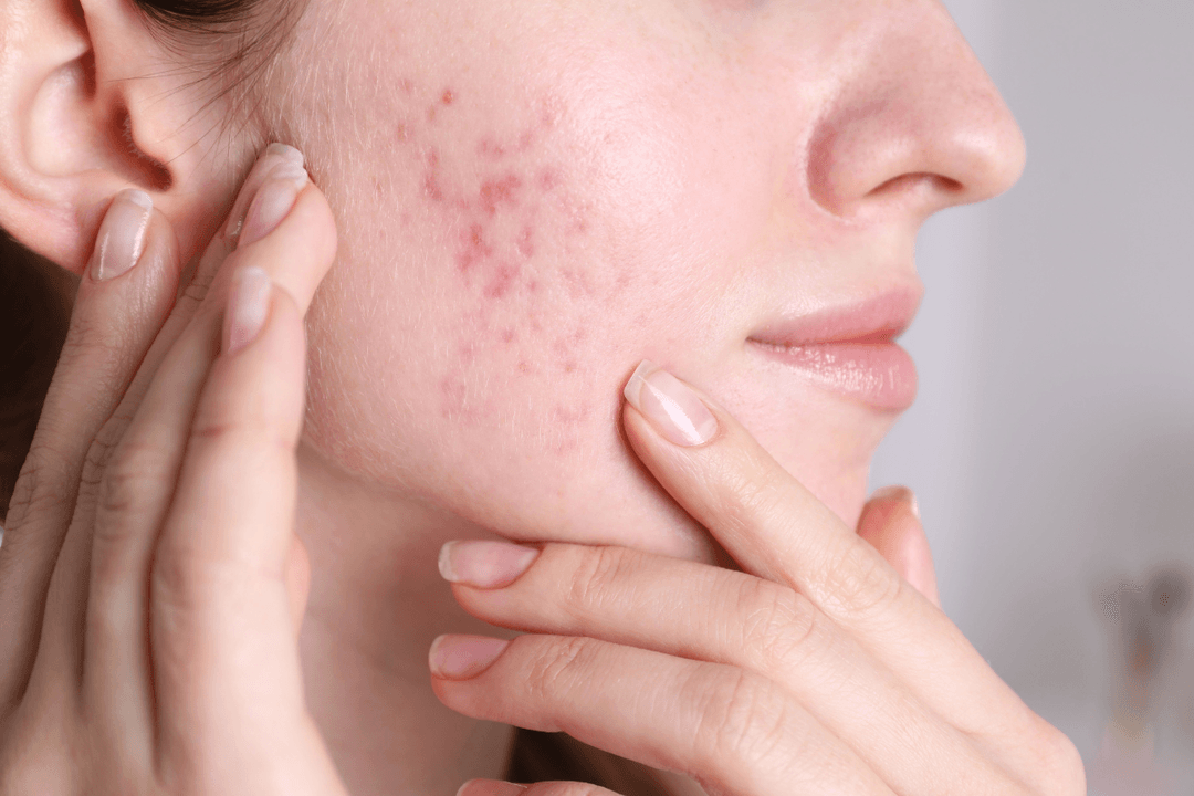 laser-acne-treatment-benefits-what-to-expect